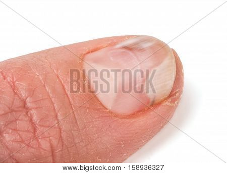 one finger of the hand with a fungus on the nails isolated on white background.