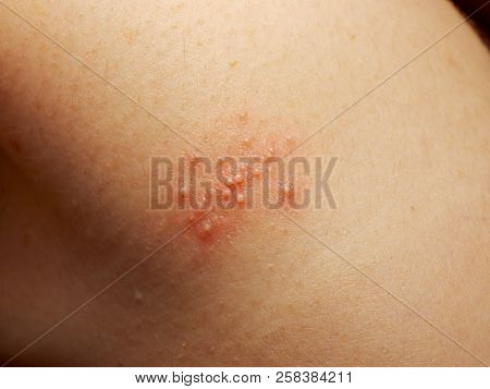 Close Up Of Girl Has Rash And Other Nonspecific Skin Eruption On Her Shoulders. May Be Caused By Dir