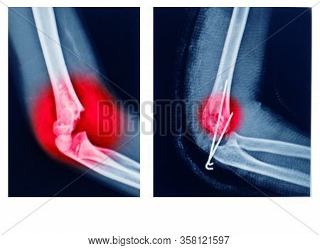 X-ray Elbow Showing  Supracondylar Humerus Fracture And Post Opretion Fix K-wire.medical Concept.