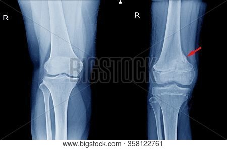 X-ray Knee Ap Views Showing  Normal Knee Joint And Fracture Distal Femur On Red Arrow Point.