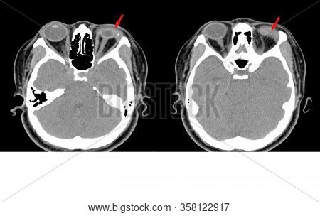 Ct-scan Brain And Orbit In Case Of Accident, The Bottle Explodes, Splashes Into The Eyes.impression: