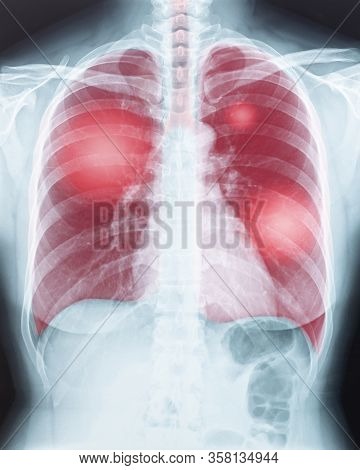 Covid-19, Coronavirus Disease Or Tuberculosis Infection On Lung Chest X-ray Radiography Imaging Film