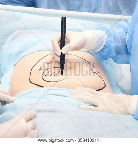 Surgery Room. Belly Surgery. Doctor Mark Liposuction Area At Tummy. Drawing At Skin. Anti Cellulite 