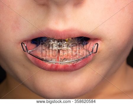 Teenage Boy Wearing Orthodontic Braces And Showing Tongue.  Teeth With Orthodontic Brackets. Dental 
