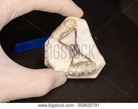 Rear Tooth Hyrax Expander. Temporary Frame Rapid Expander For Repairing Birth Defects