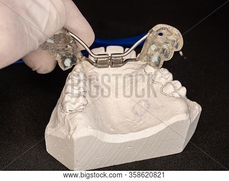 Palatal Expander For The Maxilla, Setting Test. The Removable Orthodontic Appliance To Make The Uppe