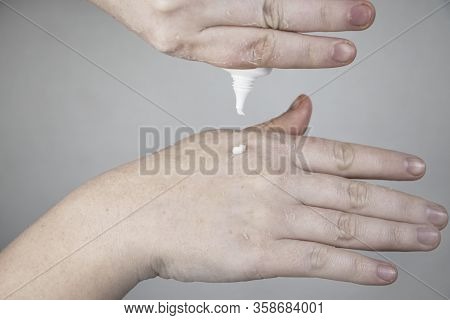 Dry Hands And Peeling Of The Skin, Mycosis. The Girl Shows Her Hands To A Doctor Dermatologist. Mois