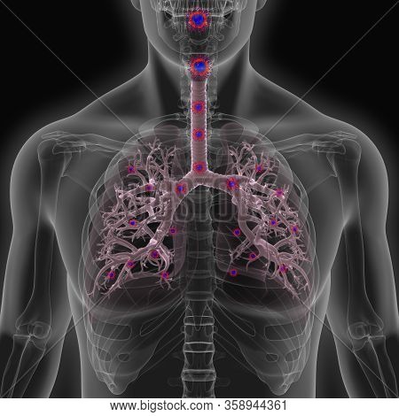 Corona Virus Disease Is An Infectious Disease Caused By A New Virus.the Disease Causes Respiratory I
