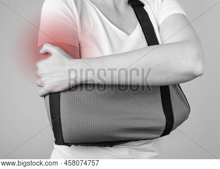 Woman Wearing Sling To Support Injured Shoulder With Red Spot. Arm Trauma, Injury, Acromion Fracture