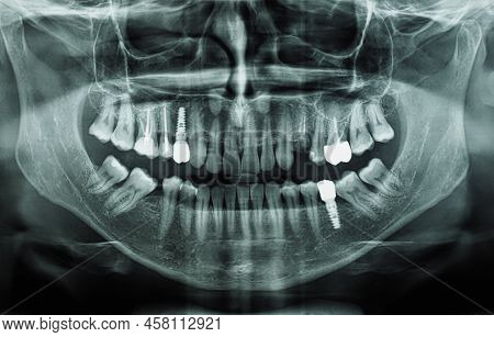 Orthopantomograph Panoramic Image Radiograph Of Teeth