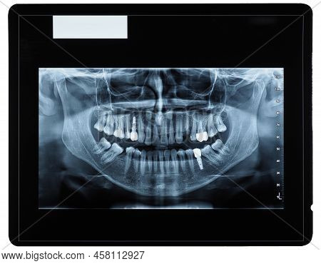 Orthopantomograph Panoramic Image Radiograph Of Teeth