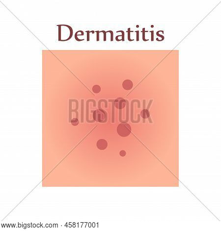 Dermatitis On Human Skin. Dermatological Disease. The Symptom Is Itching, Pain, Redness And Rash. Al