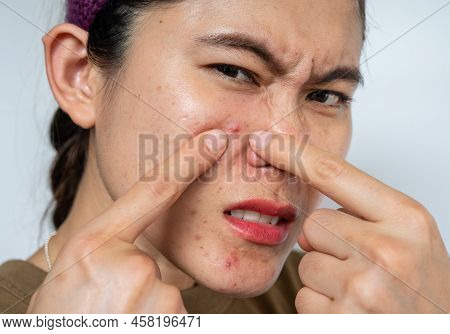 Asian Woman Pointing To Acne Inflamed On Her Face. Inflamed Acne Consists Of Swelling, Redness, And 