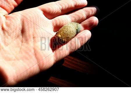 Gallstone Disease, Cholelithiasis - The Formation Of Stones, Stones In The Gallbladder, Bile Ducts. 