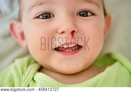 Happy Toddler Baby Boy With A Bloody Nose. Bleeding From The Nose Of A Smiling Child. Kid At The Age