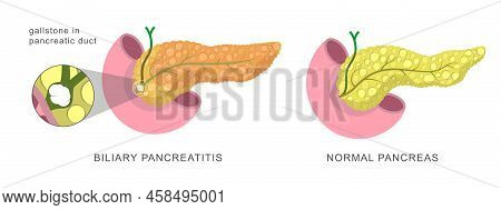 Acute Pancreas Inflamation Caused By The Obstruction Of The Pancreatic Duct With Stones. Biliary Pan