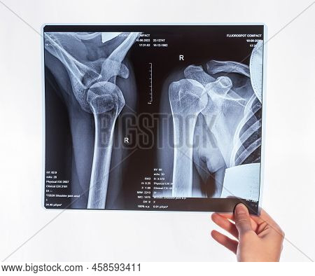 Hand Holding Shoulder, Clavicle X-ray Image. Acromion, Acromial End Fracture. Arm Injury. Health Car