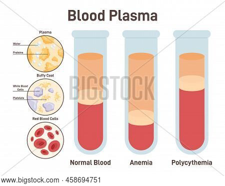 Blood Plasma. Structure Of Normal Blood, Blood With Anemia