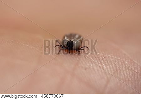 Tick Filled With Blood Sitting On Human Hand Skin. Ixodes Ricinus Or Scapularis. Close-up Of Dangero