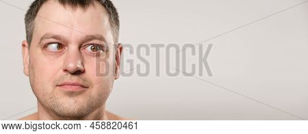 A Man With Strabismus Squints His Eyes On A White Background, A Banner With Space For Text.