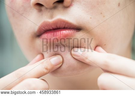 Acne Pimple And Scar On Skin Face, Disorders Of Sebaceous Glands, Teenage Girl Skincare Beauty Probl