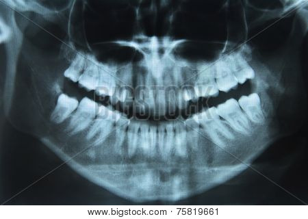 Dental Xray
