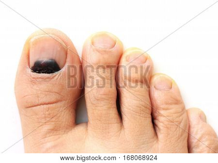 Bruise on Big Toe Nail one month after the accident