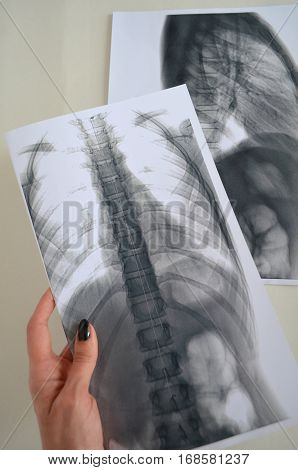X-ray of a human spine - scoliosis diagnosis delivered by the expert