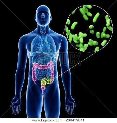 3d rendered medically accurate illustration of a mans colon infection