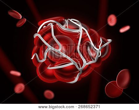 3d Illustration Of Illustration Of A Blood Clot, Thrombus Or Embolus With Coagulated Red Blood Cells