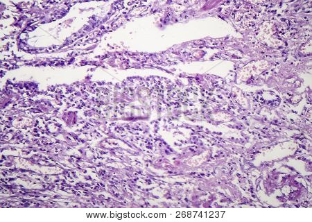 Histopathology Of Viral Pneumonia, Light Micrograph, Photo Under Microscope