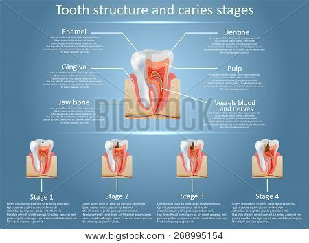 Vector Tooth Structure Diagram And Dental Caries Stages