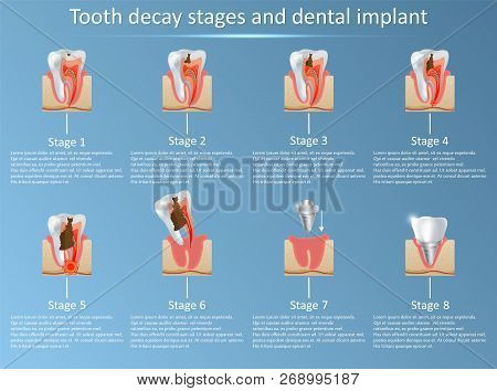 Tooth Decay Stages And Dental Implant Vector Illustration