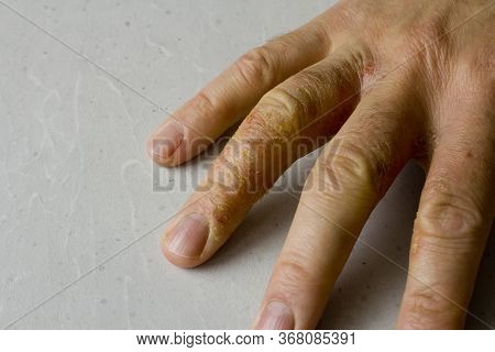 Closeup Of Eczema Dermatitis On Man Hand And Fingers. Skin Peeling,desquamation Of Hand, Gray Modern