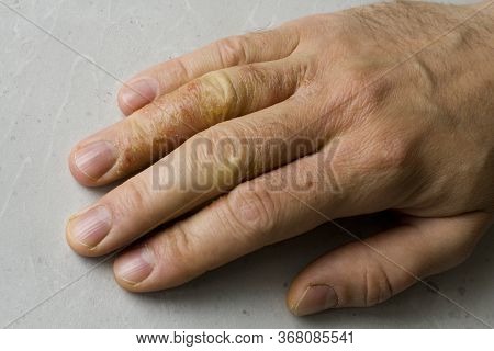Closeup Of Eczema Dermatitis On Man Hand And Fingers. Skin Peeling,desquamation Of Hand, Gray Modern