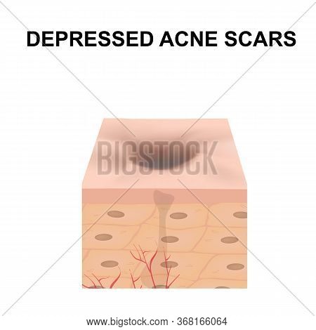Atrophic Scars. Acne Scar. The Anatomical Structure Of The Skin With Acne. Illustration On Isolated 