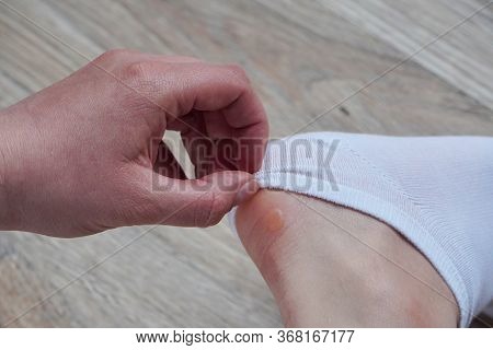 Water Corns On Heels Of A Woman In White Socks, Rub The Calluses With New Shoes. Grated Bloody Blown