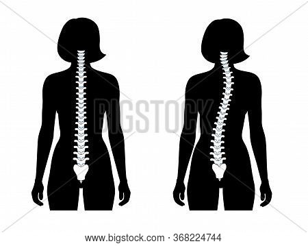 Woman Scoliosis Flat Vector Illustration. Types Of Scoliosis Of Spine Infographics. Diagram With Spi