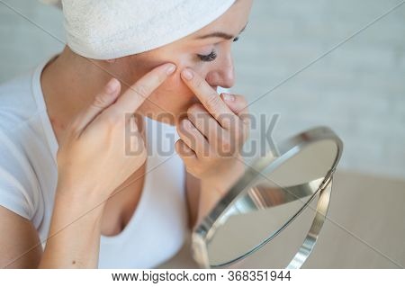 Caucasian Woman With A White Terry Towel On Her Head Crushes Pimple. Problem Skin During Menstruatio