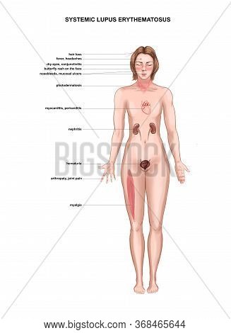Illustration Of Symptoms Of Systemic Lupus Erythematosus