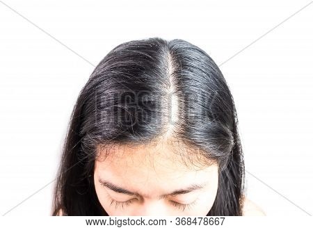 Women Head With Dandruff Caused By The Problem Of Dirty. Or Caused By Skin Disease Or Seborrheic Der