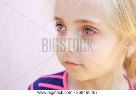 Close Up Of A Girl With Conjunctivitis .