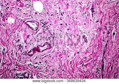 Breast Ductal Carcinoma, Light Micrograph, Photo Under Microscope