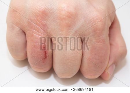 Hand Dermatitis. Hand Eczema Closed On White Background
