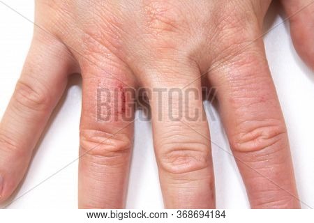 Hand Dermatitis. Hand Eczema Closed On White Background