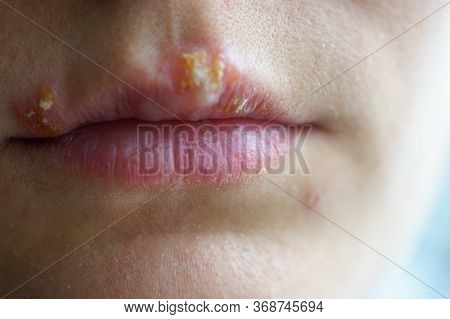Herpes Disease On The Lips Of A Young Girl. Wounds From Herpes On The Lips Of A Person. Herpes Foci.