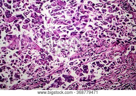 Breast Ductal Carcinoma, Light Micrograph, Photo Under Microscope