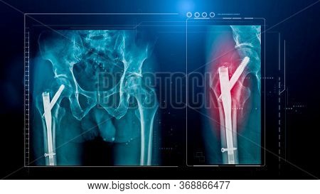 X-ray Image Of Shoulder With Scapular Fracture