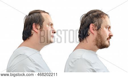 Portrait Of A Man 35-40 Years Old With A Beard And Without A Beard, Face In Profile, Isolated On A W