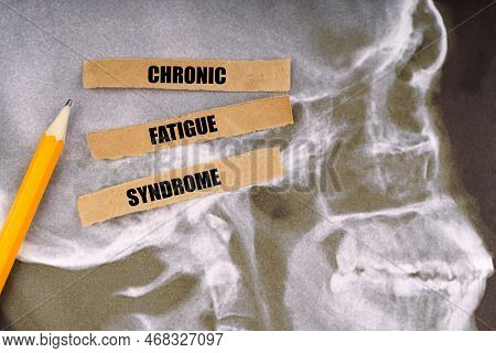 Medical Concept. On X-rays Of A Human Skull, A Pencil And Strips Of Paper With The Inscription - Chr